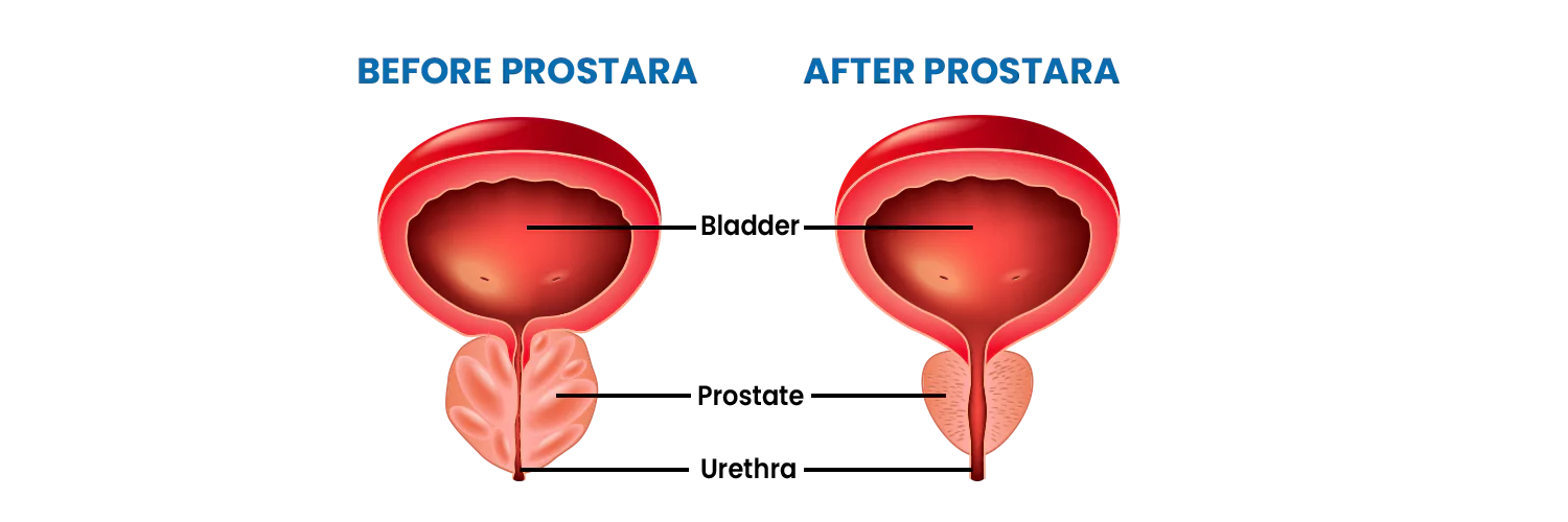 Before and After Prostara